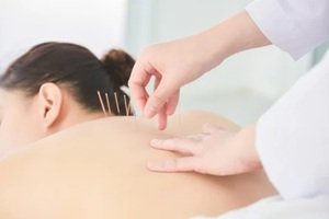 hands of therapist doing acupuncture at patient back